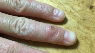 こどものイボ治療